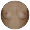 Prothèses mammaires - Patientes menues