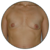 Prothèses mammaires - Patientes aux seins asymétriques