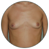 Prothèses mammaires - Patientes aux seins écartés