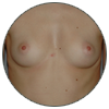 Prothèses mammaires - Patientes aux seins rapprochés