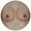 Prothèses mammaires - Patientes aux petits seins