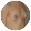 Prothèses mammaires - Patientes aux seins tubéreux